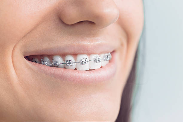 Best Invisalign and Clear Aligners  in Aberdeen, SD